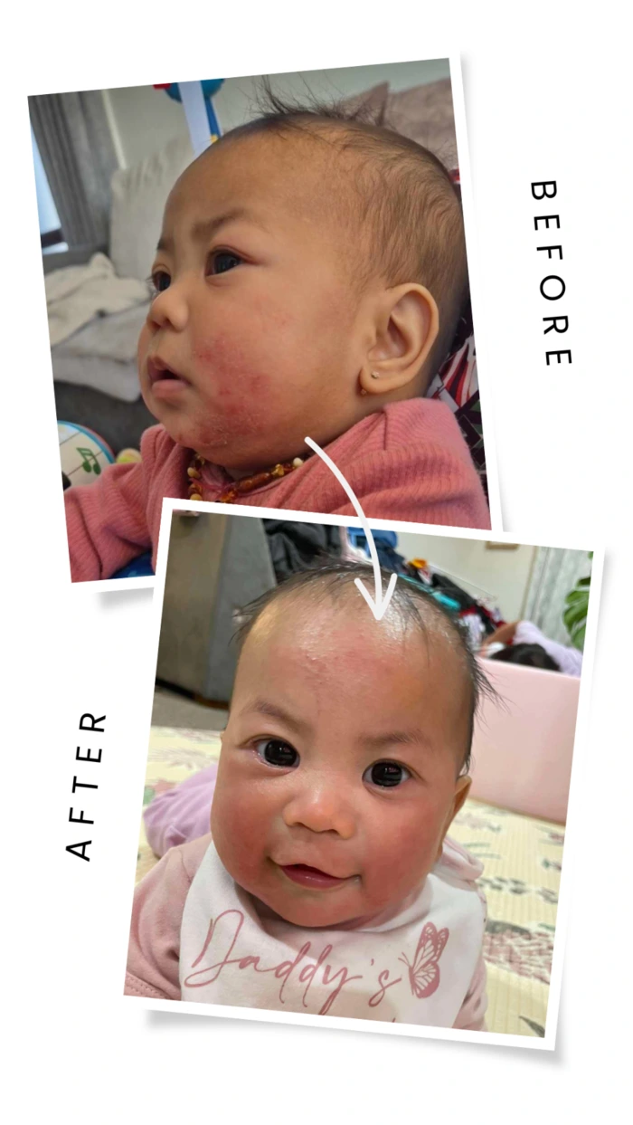 Baby eczema results