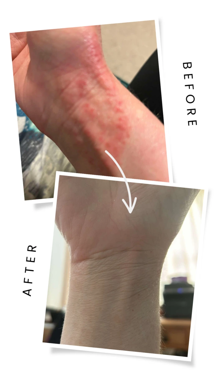 Eczema results